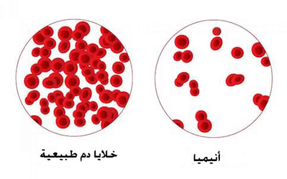 فقر الدم