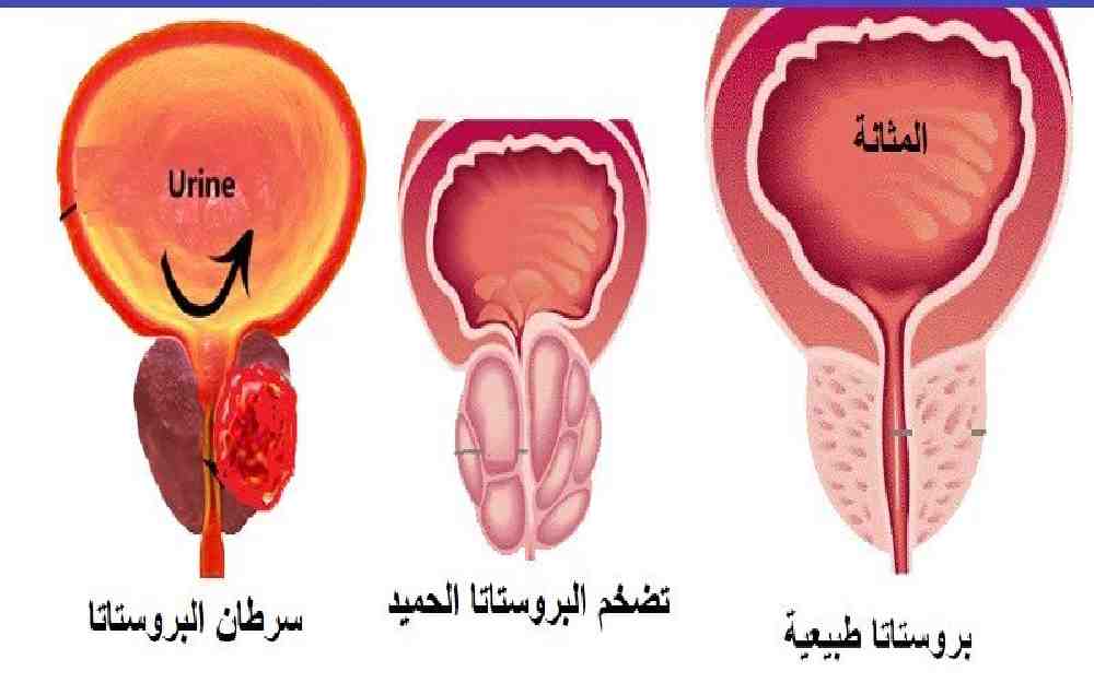 تضخّم البروستاتا