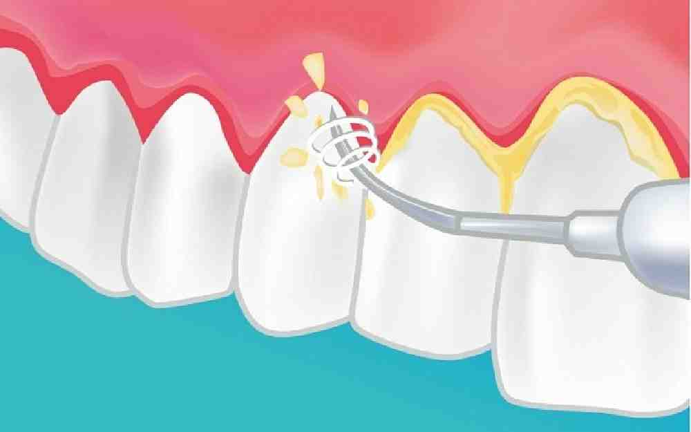 إزالة البكتيريا المسببة لتسوس الأسنان